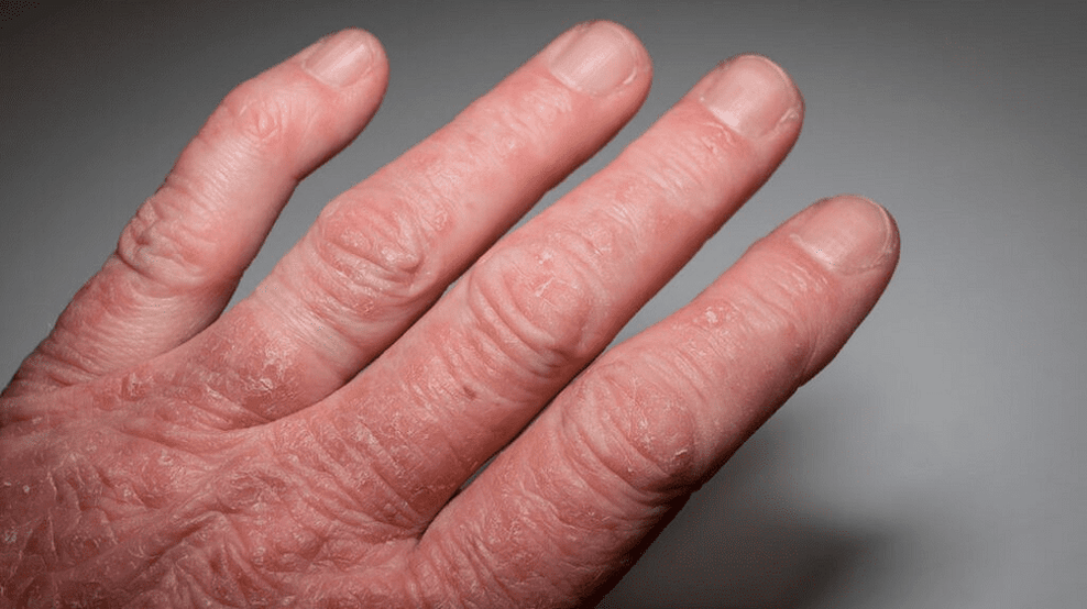 Artrite psoriásica nas mans