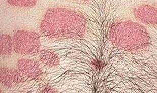 Varias formacións rosas no estómago