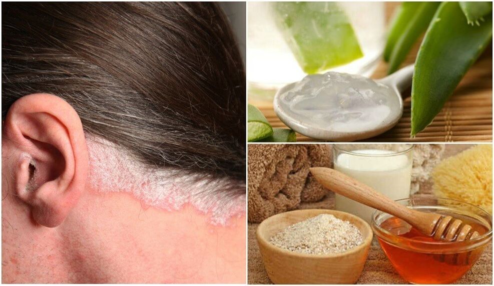 Tratamento da psoríase con remedios populares