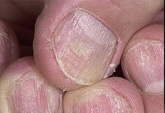 Psoríase das uñas