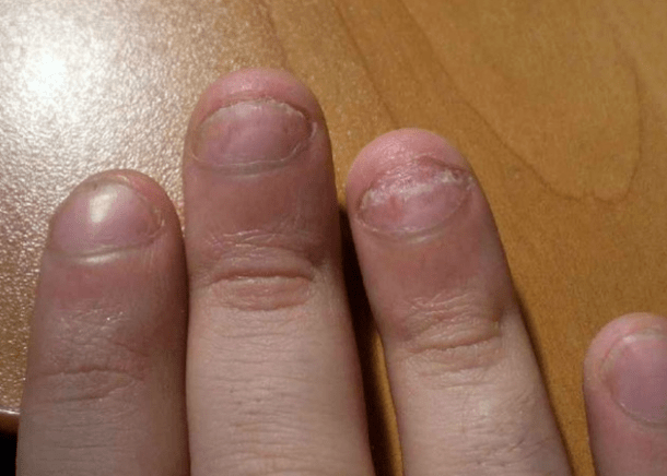 Psoríase das uñas