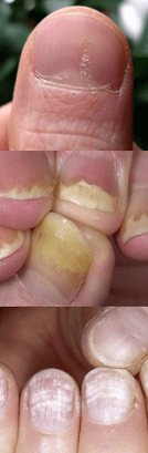 Psoríase das uñas - Etapas iniciais