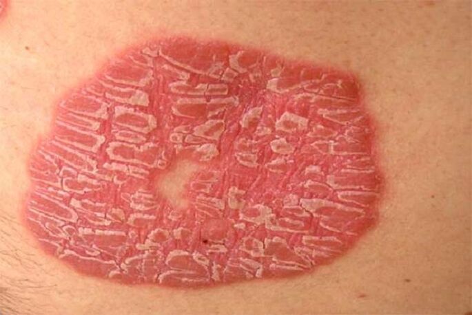 psoríase pustulosa