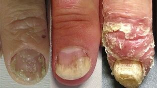 Etapas de desenvolvemento da psoríase das uñas